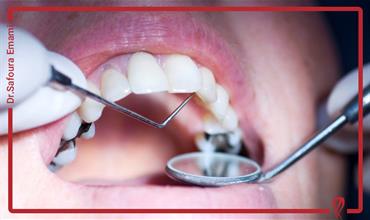 عمر و دوام دندان پر شده چقدر است؟